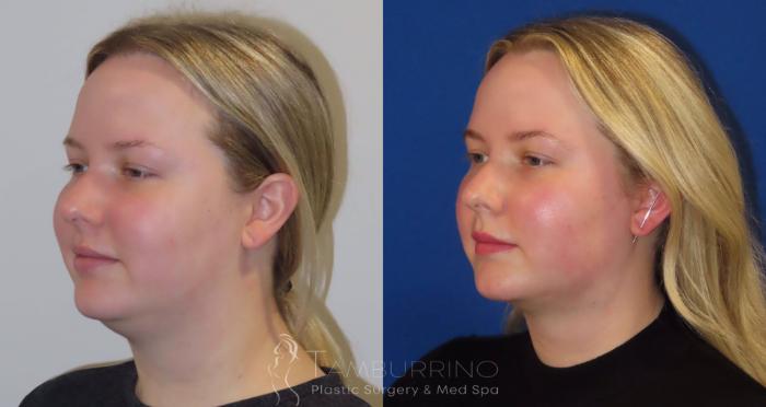 Before & After Liposuction Case 23 Oblique #2 View in Doylestown, PA