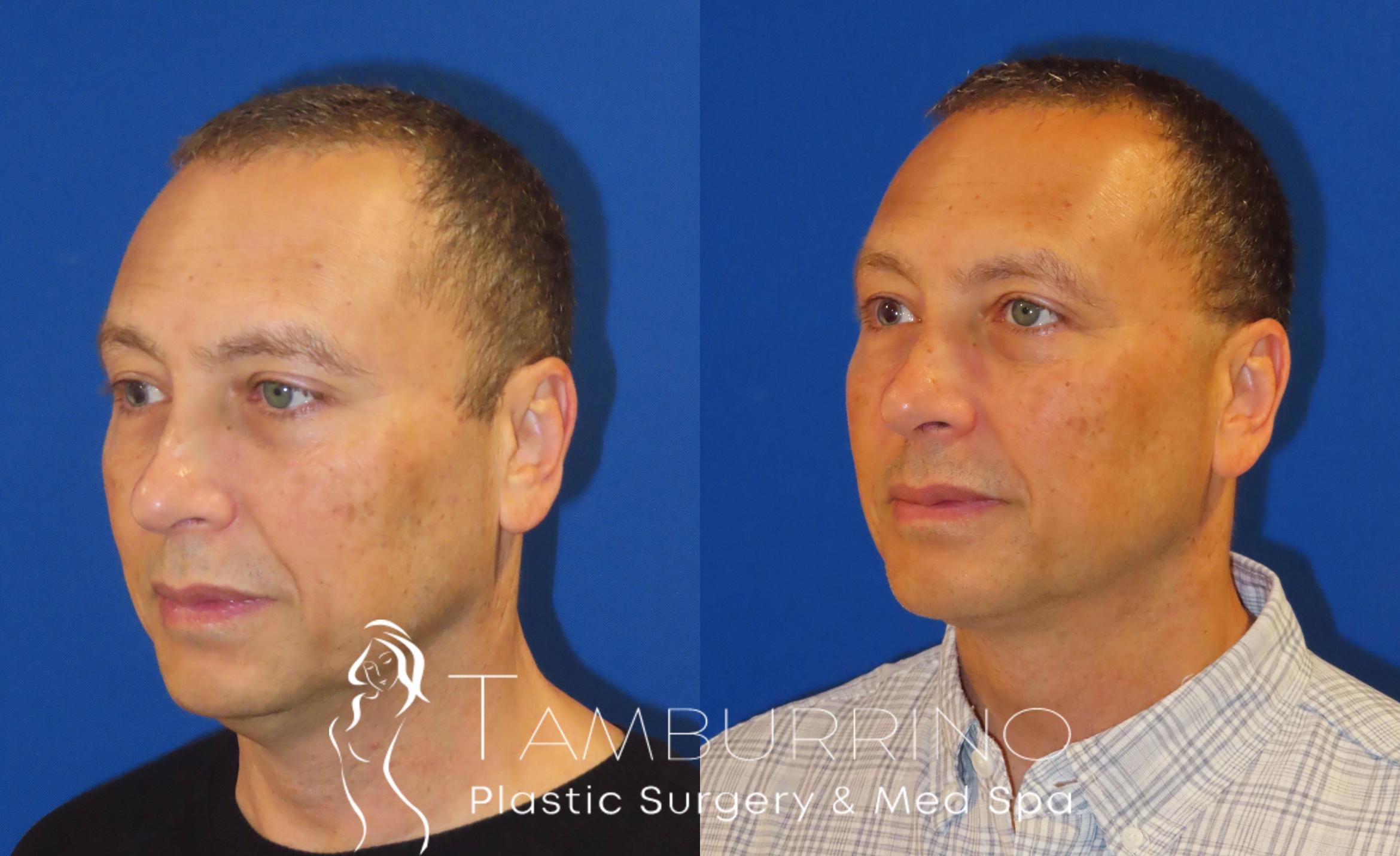 Before & After Liposuction Case 41 Left Oblique View in Doylestown, PA