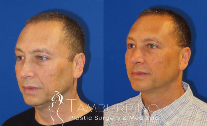 Before & After Liposuction Case 41 Left Oblique View in Doylestown, PA