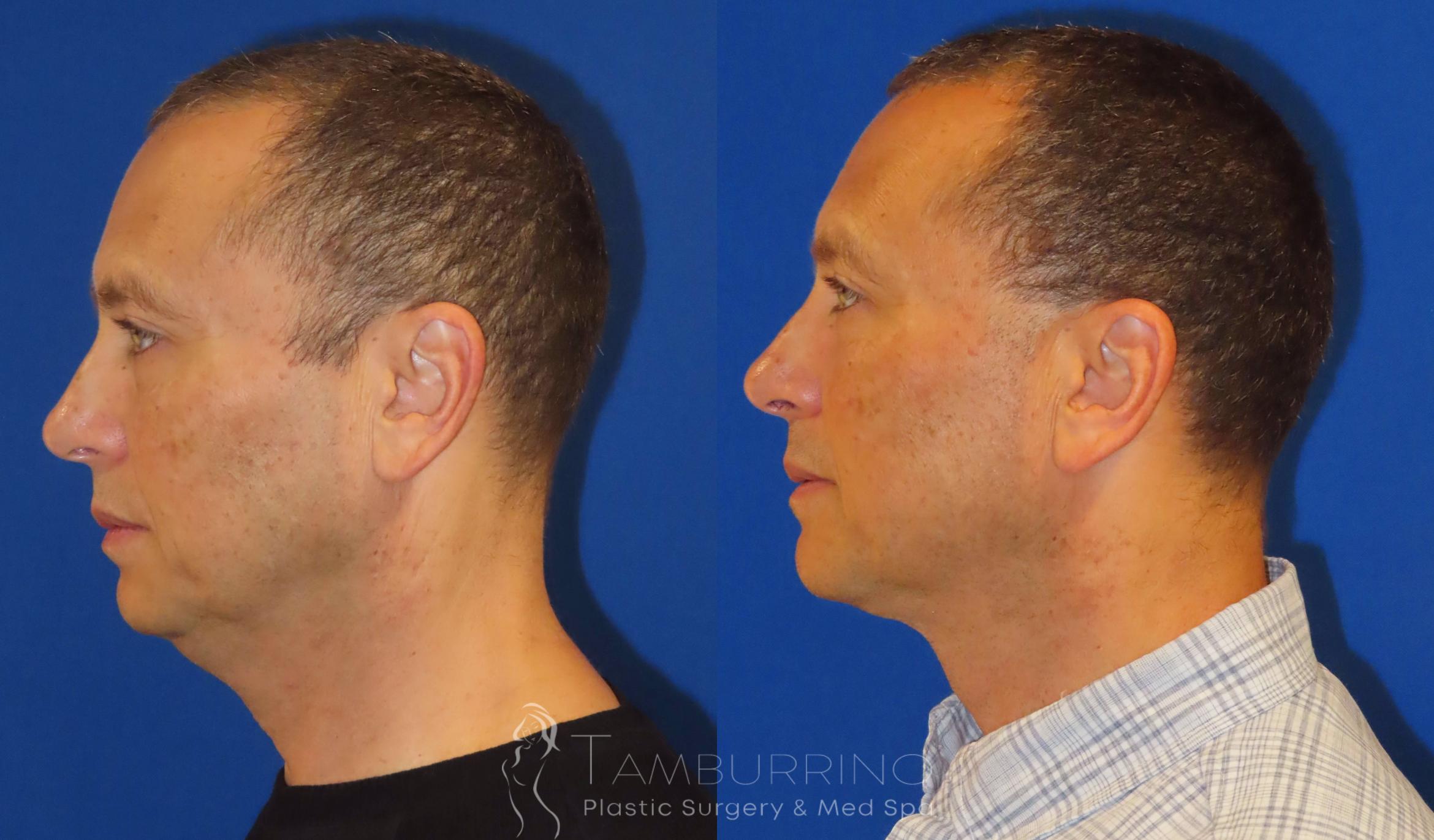 Before & After Liposuction Case 41 Left Side View in Doylestown, PA