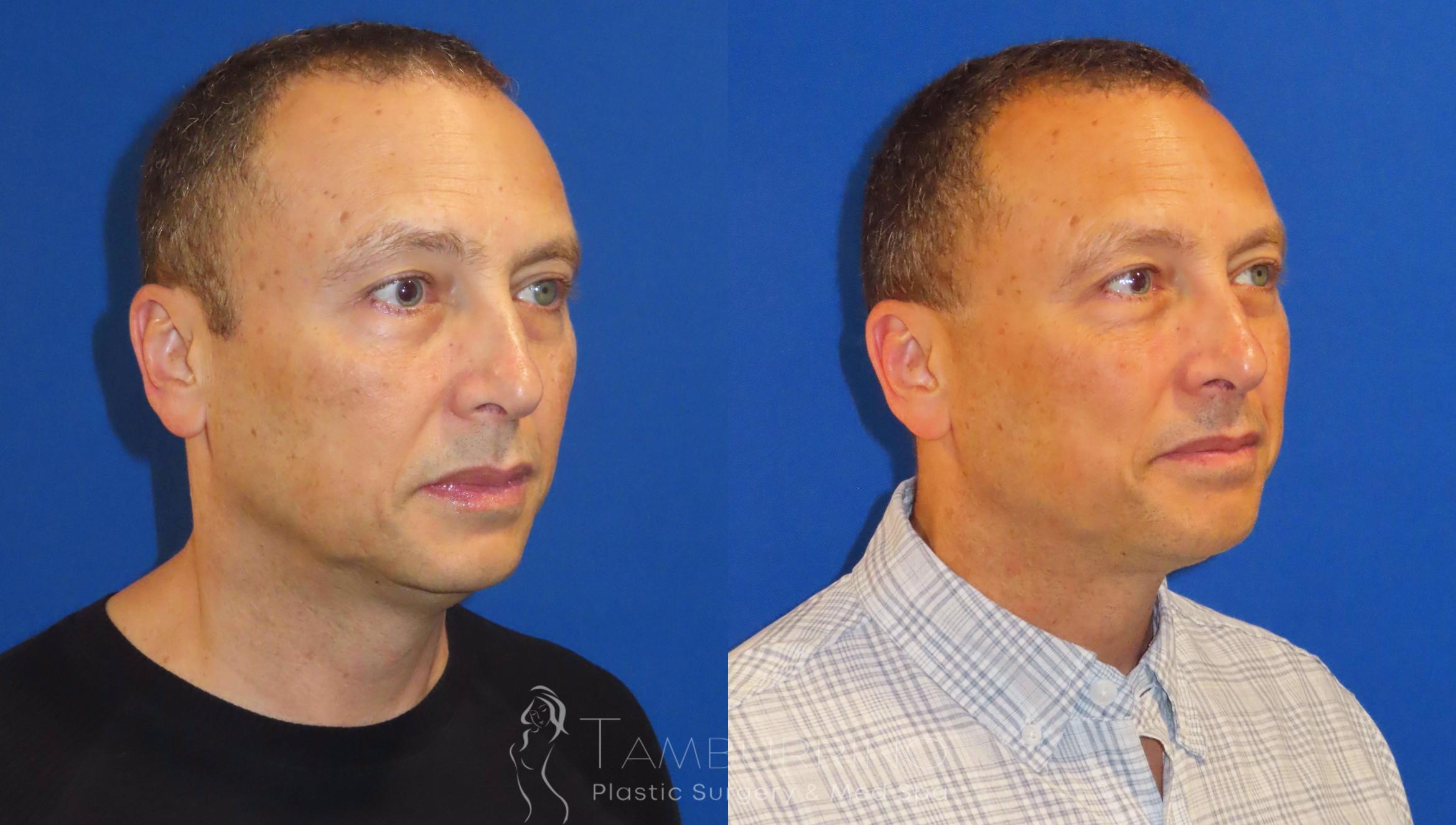 Before & After Liposuction Case 41 Right Oblique View in Doylestown, PA