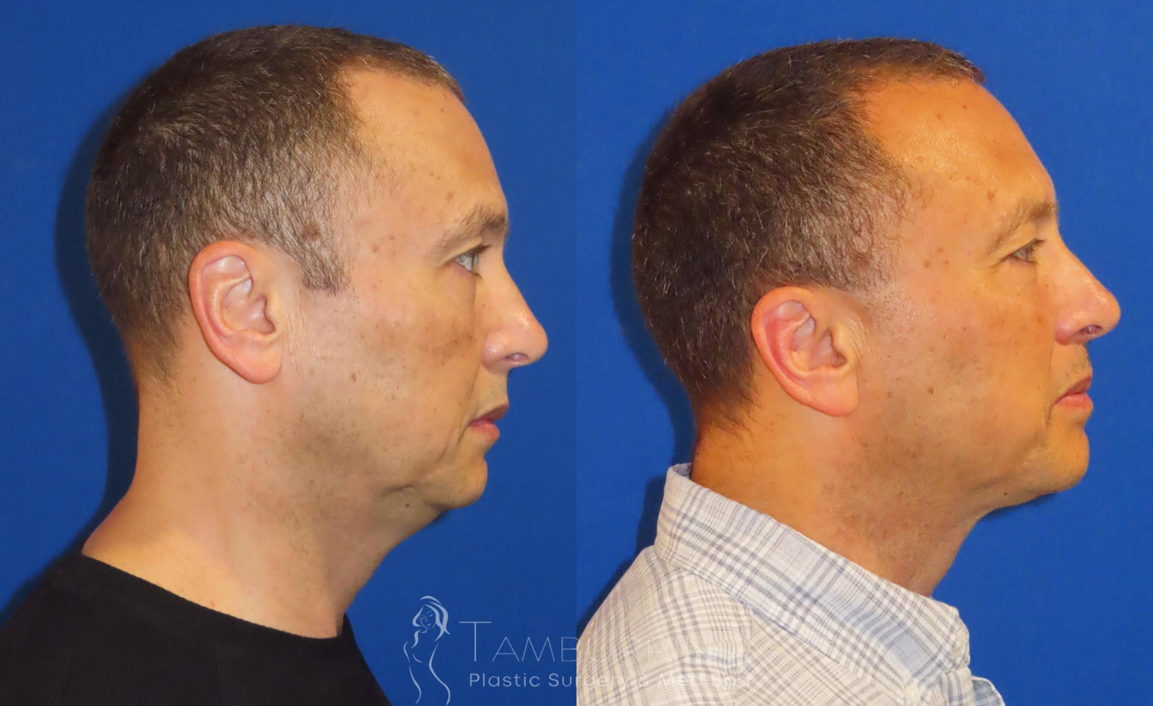 Before & After Liposuction Case 41 Right Side View in Doylestown, PA
