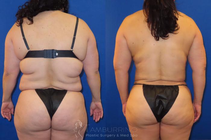 Before & After Body Contouring Case 52 Back View in Doylestown, PA