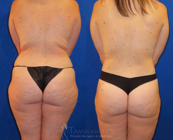 Before & After Liposuction Case 56 Back View in Doylestown, PA