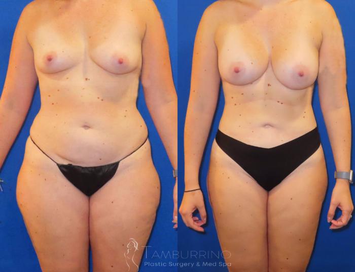 Before & After Liposuction Case 56 Frontal View in Doylestown, PA