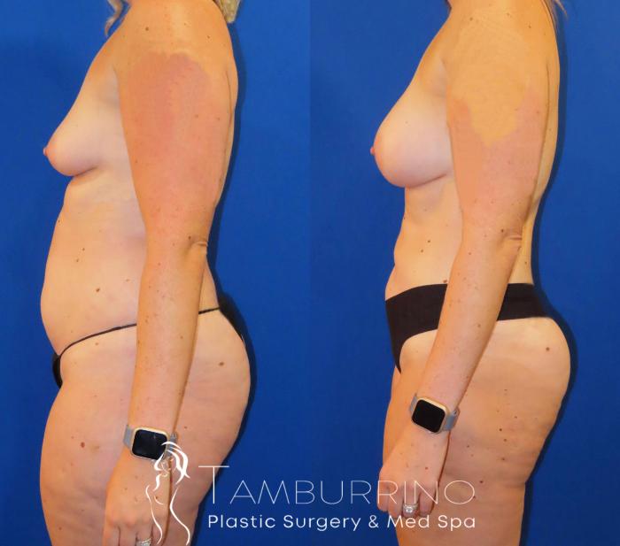 Before & After Liposuction Case 56 Left Side View in Doylestown, PA