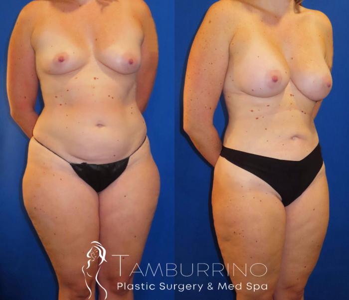 Before & After Liposuction Case 56 Right Oblique View in Doylestown, PA