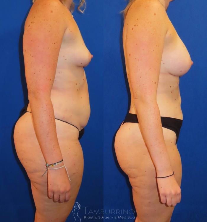 Before & After Liposuction Case 56 Right Side View in Doylestown, PA