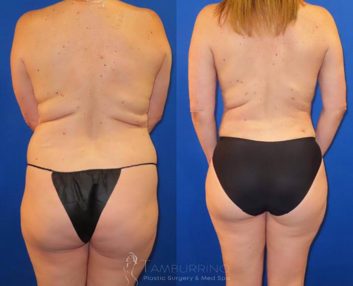 Before & After Brazilian Butt Lift Case 58 Back View in Doylestown, PA