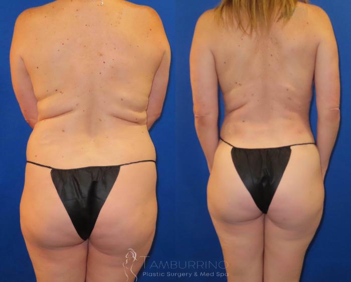 Before & After Liposuction Case 62 Back View in Doylestown, PA