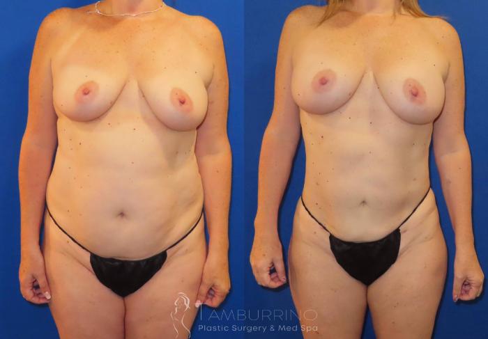 Before & After Liposuction Case 62 Frontal View in Doylestown, PA