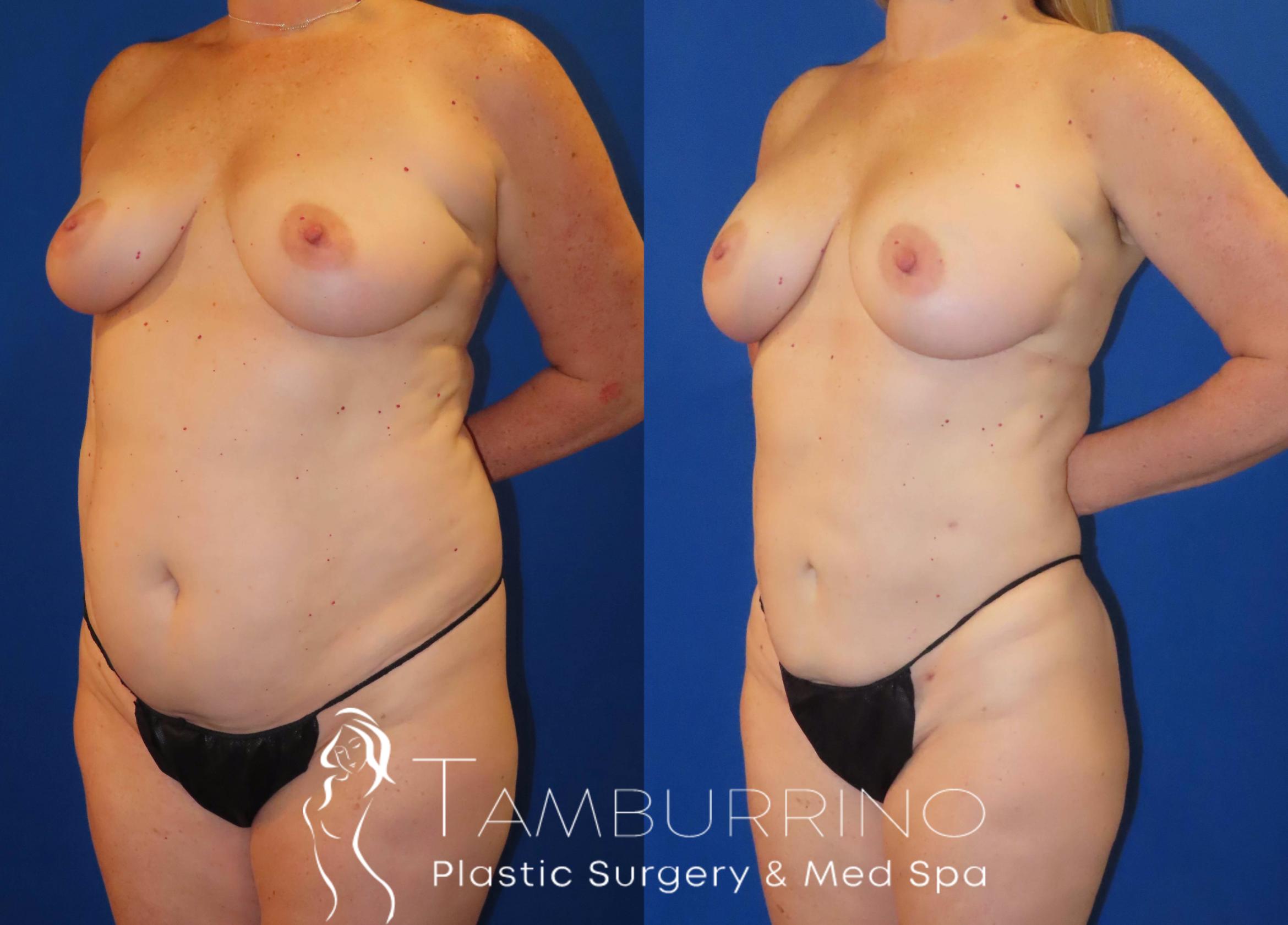 Before & After Liposuction Case 62 Left Oblique View in Doylestown, PA