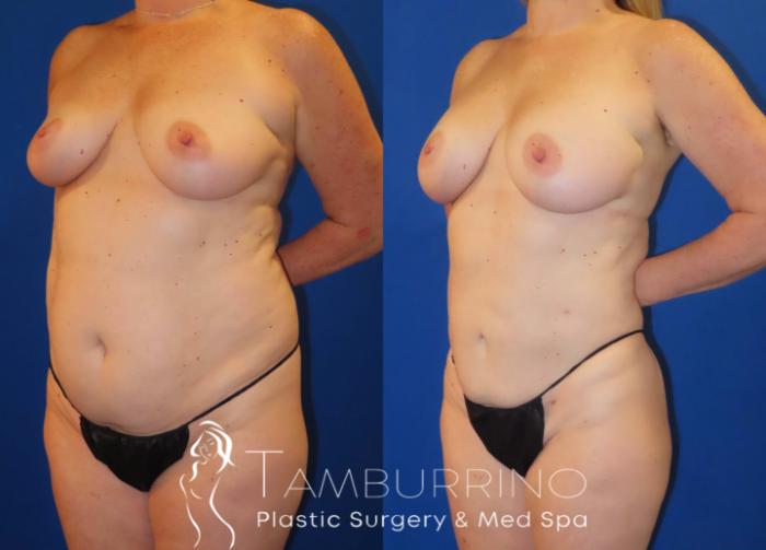 Before & After Liposuction Case 62 Left Oblique View in Doylestown, PA