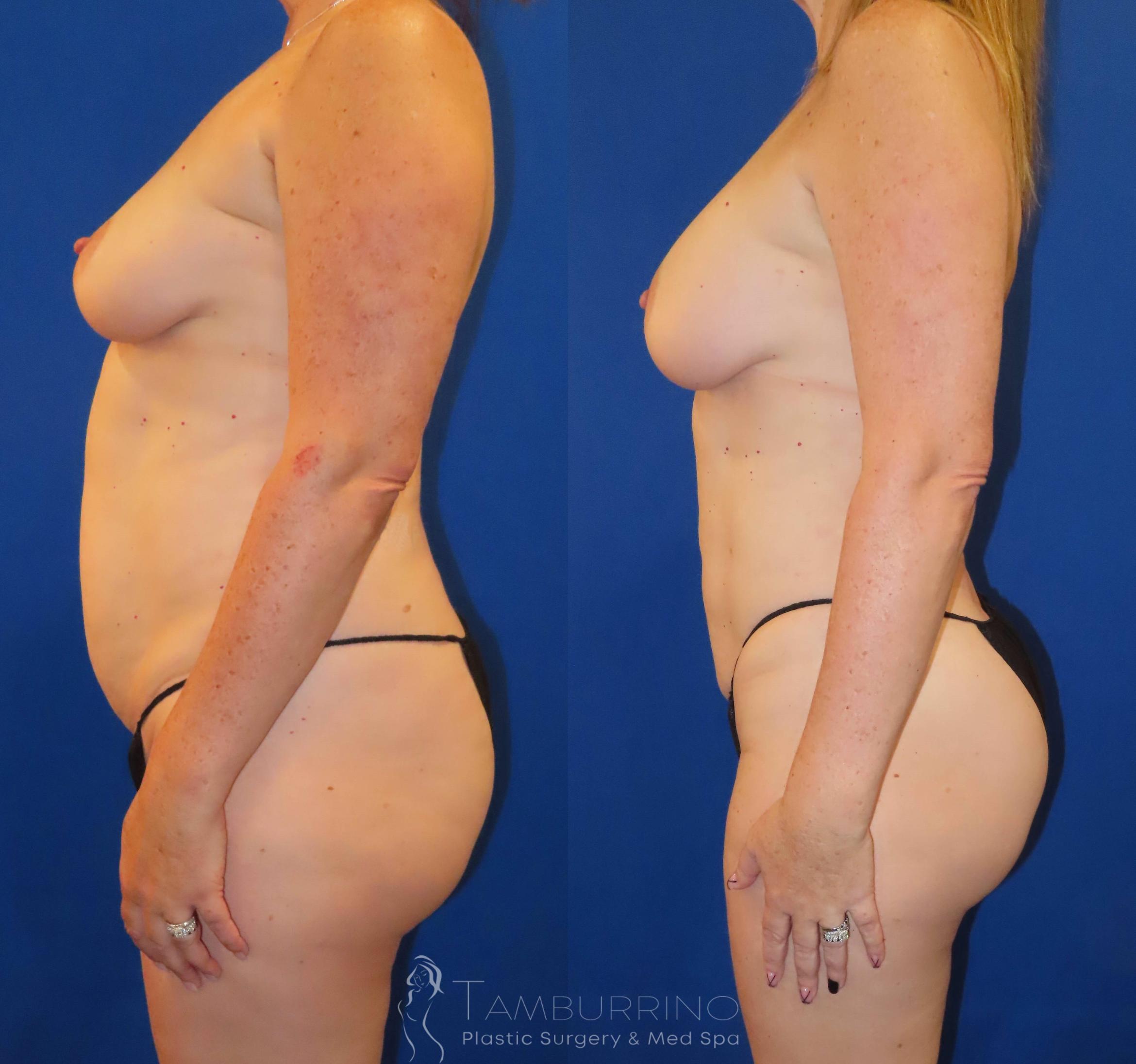 Before & After Liposuction Case 62 Left Side View in Doylestown, PA