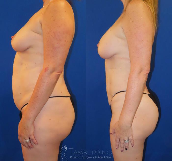 Before & After Liposuction Case 62 Left Side View in Doylestown, PA