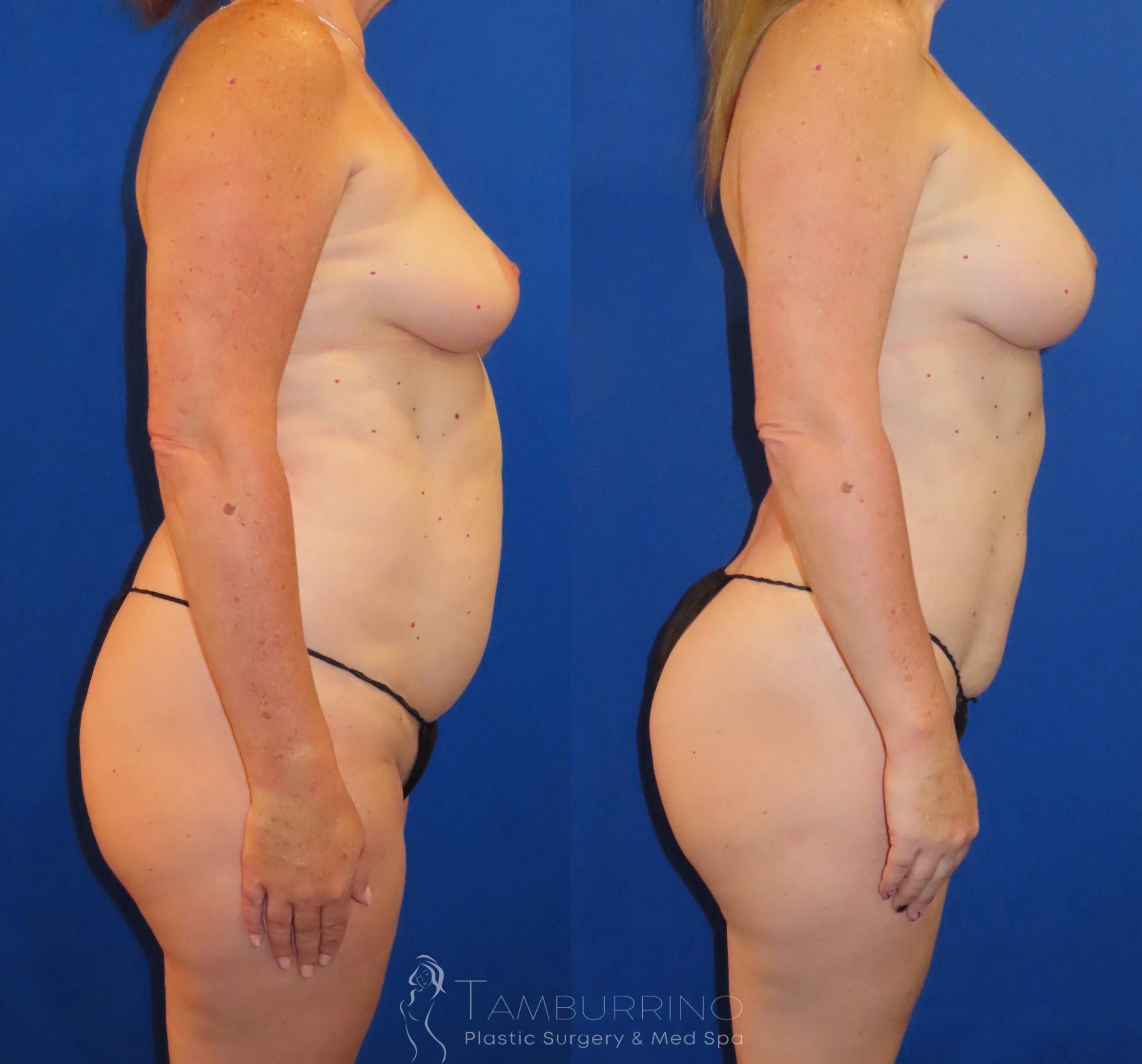 Before & After Liposuction Case 62 Right Side View in Doylestown, PA
