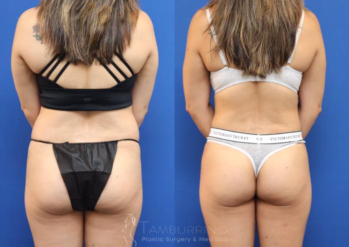 Before & After Liposuction Case 78 Back View in Doylestown, PA