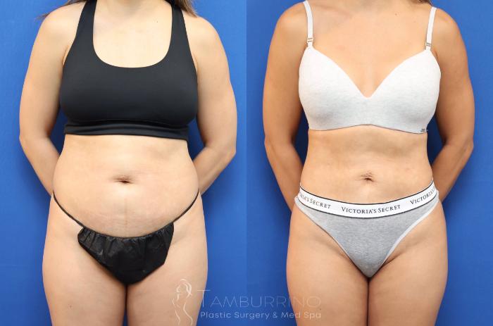 Before & After Liposuction Case 78 Front View in Doylestown, PA
