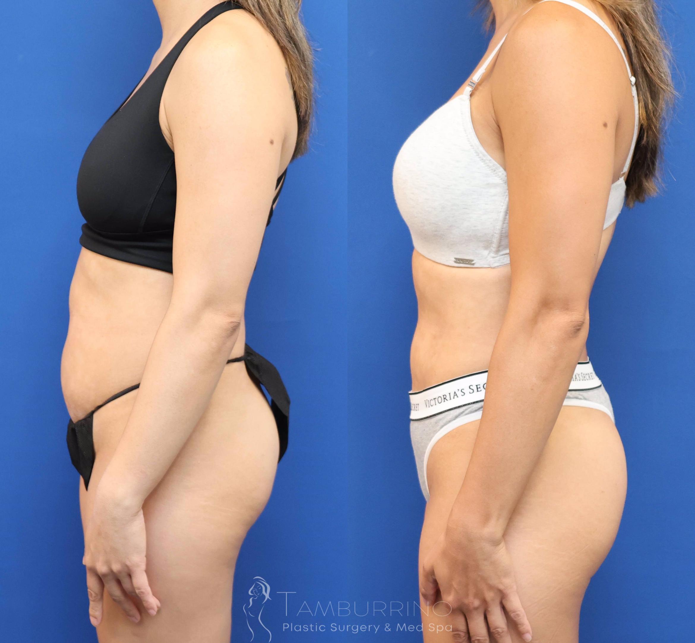 Before & After Liposuction Case 78 Left Lateral View in Doylestown, PA