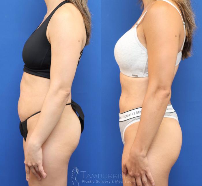 Before & After Liposuction Case 78 Left Lateral View in Doylestown, PA