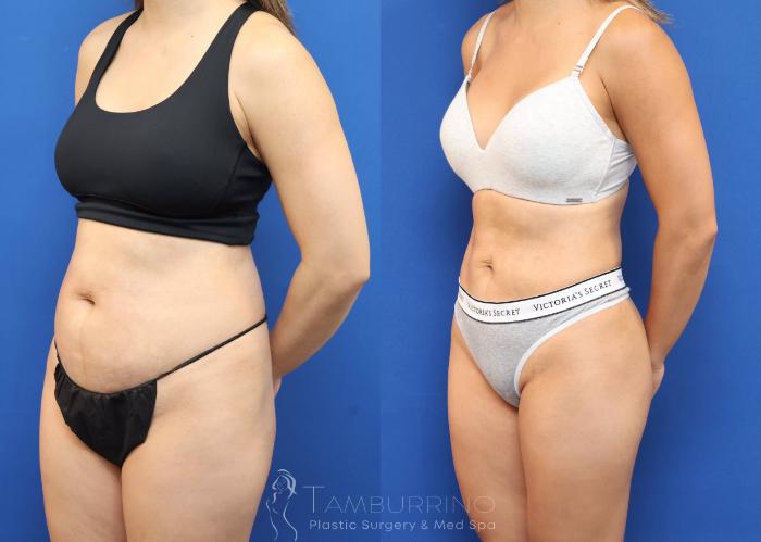 Before & After Liposuction Case 78 Left Oblique View in Doylestown, PA