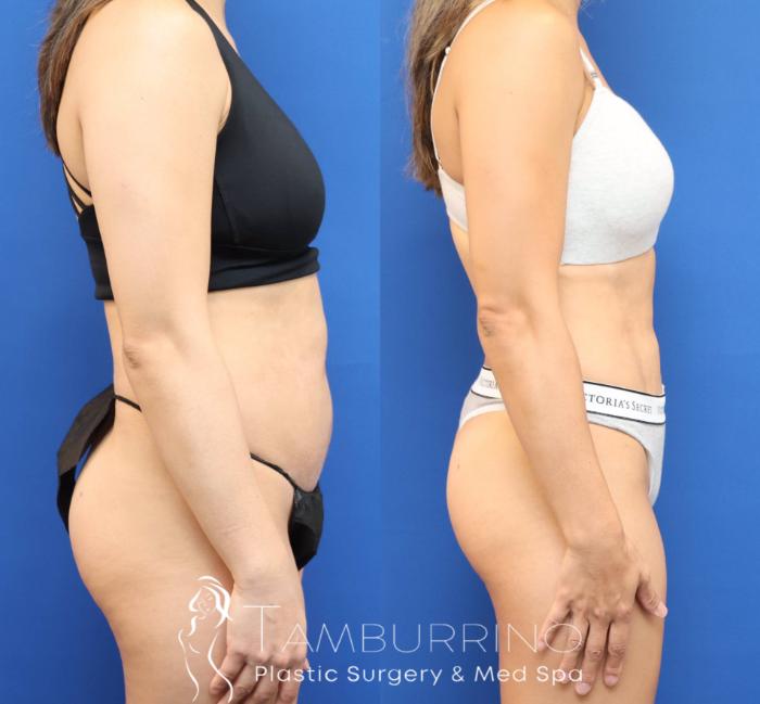 Before & After Liposuction Case 78 Right Lateral View in Doylestown, PA