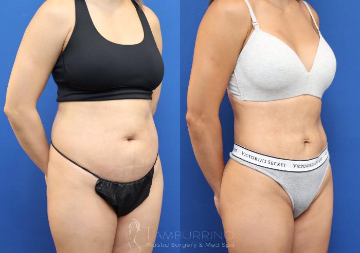 Before & After Liposuction Case 78 Right Oblique View in Doylestown, PA