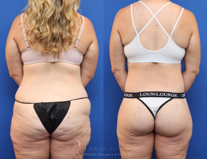 Before & After Lower Body Lift Case 83 Back View in Doylestown, PA