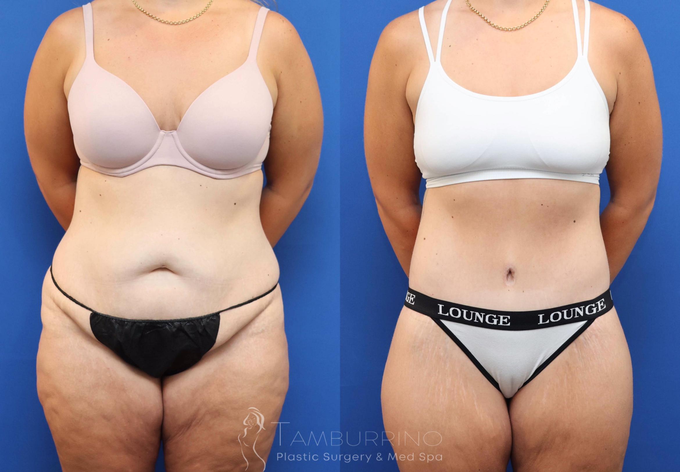 Before & After Lower Body Lift Case 83 Front View in Doylestown, PA