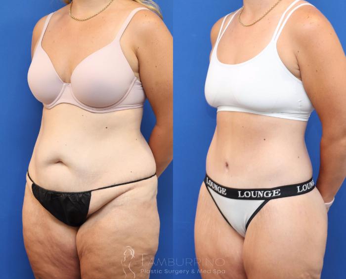 Before & After Lower Body Lift Case 83 Left Oblique View in Doylestown, PA