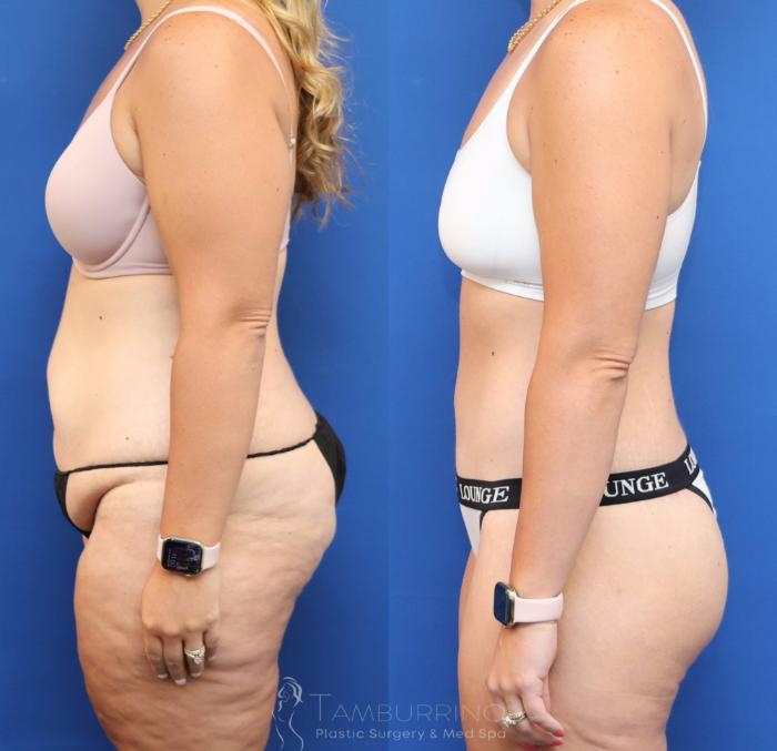 Before & After Lower Body Lift Case 83 Left Side View in Doylestown, PA
