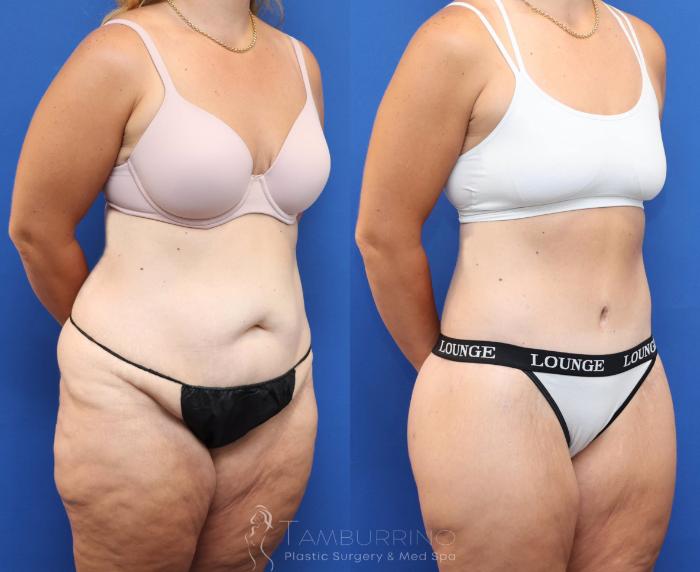 Before & After Lower Body Lift Case 83 Right Oblique View in Doylestown, PA