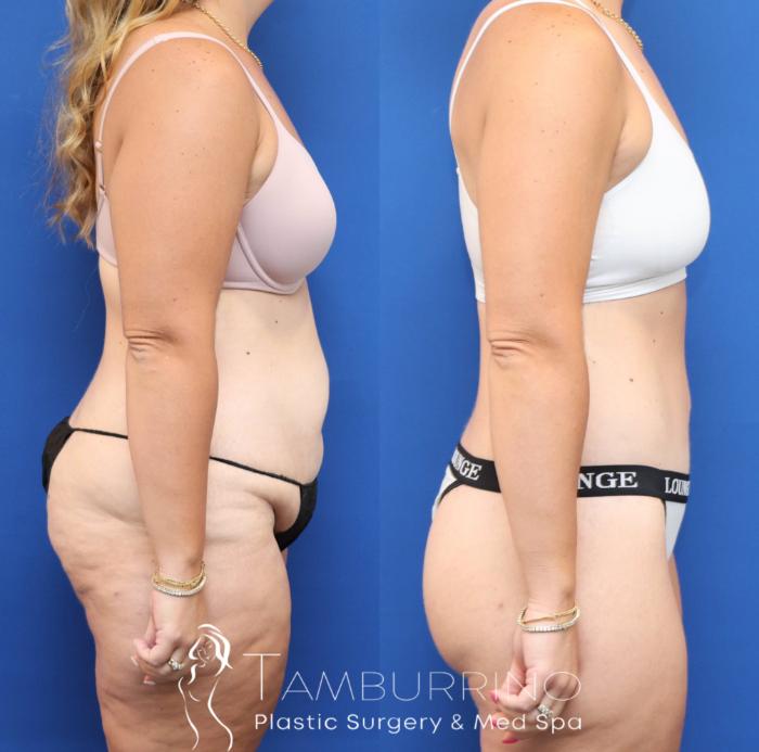 Before & After Lower Body Lift Case 83 Right Side View in Doylestown, PA