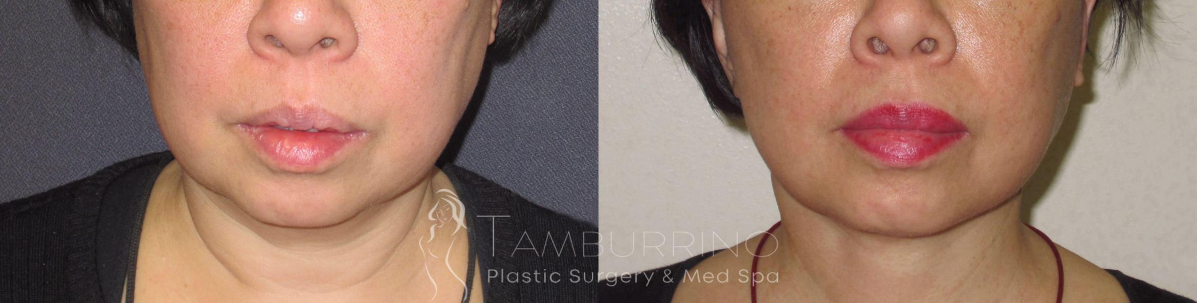 Before & After Neck Lift Case 44 Front View in Doylestown, PA