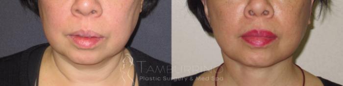 Before & After Neck Lift Case 44 Front View in Doylestown, PA