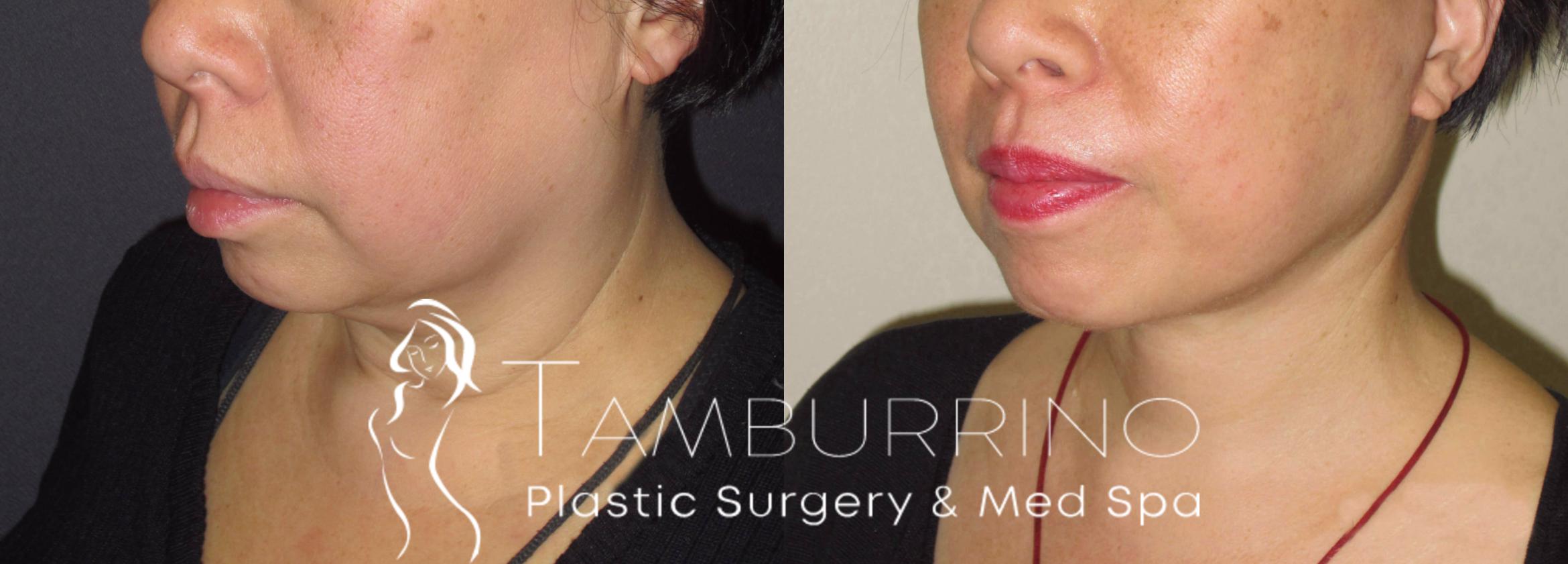 Before & After Neck Lift Case 44 Left Oblique View in Doylestown, PA