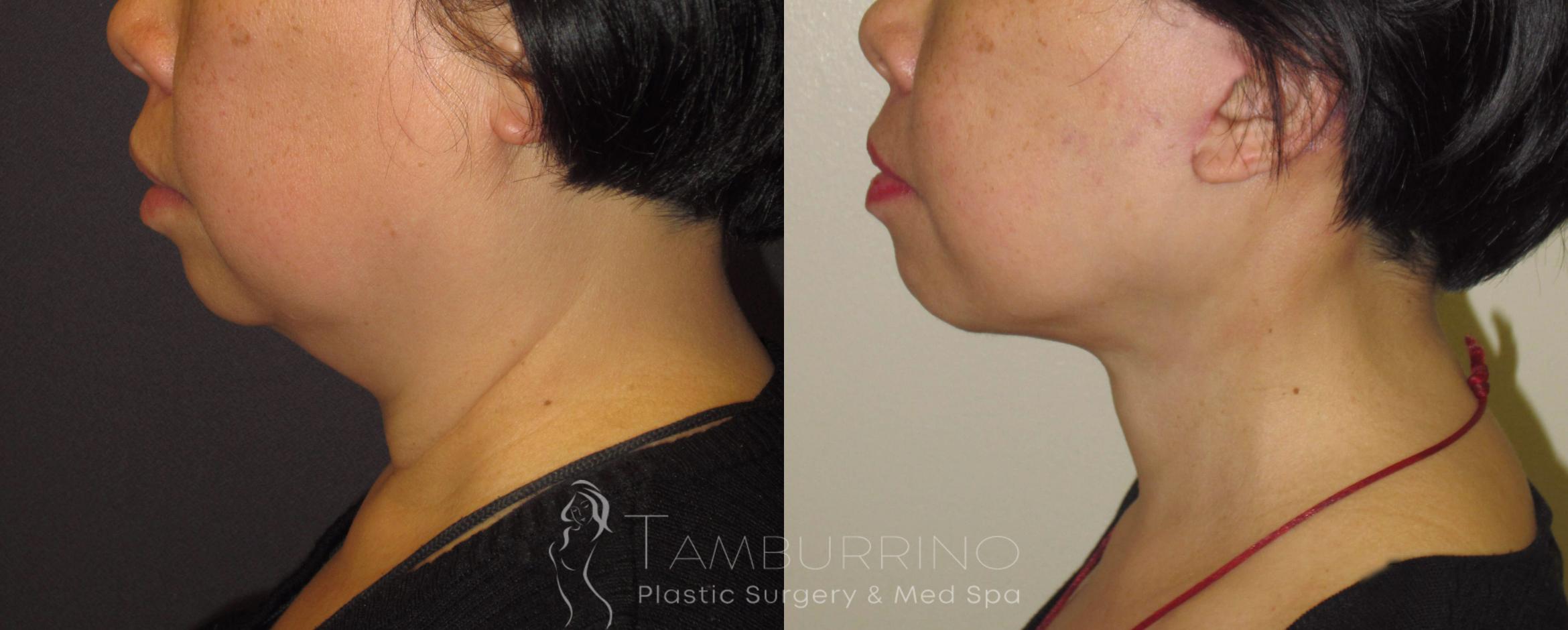 Before & After Neck Lift Case 44 Left Side View in Doylestown, PA