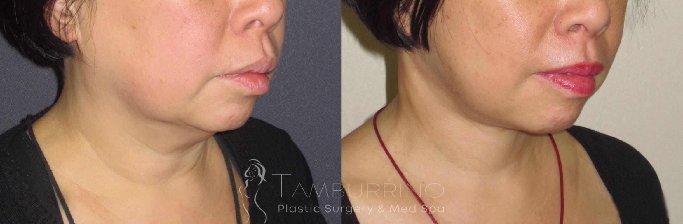 Before & After Neck Lift Case 44 Right Oblique View in Doylestown, PA