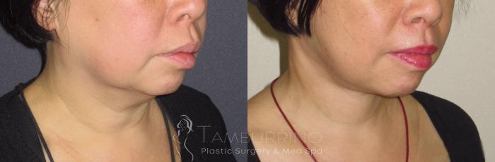 Before & After Neck Lift Case 44 Right Oblique View in Doylestown, PA