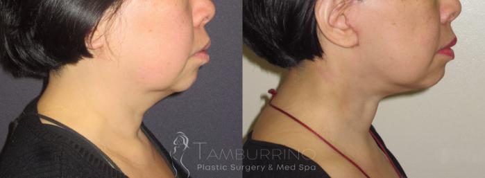 Before & After Neck Lift Case 44 Right Side View in Doylestown, PA