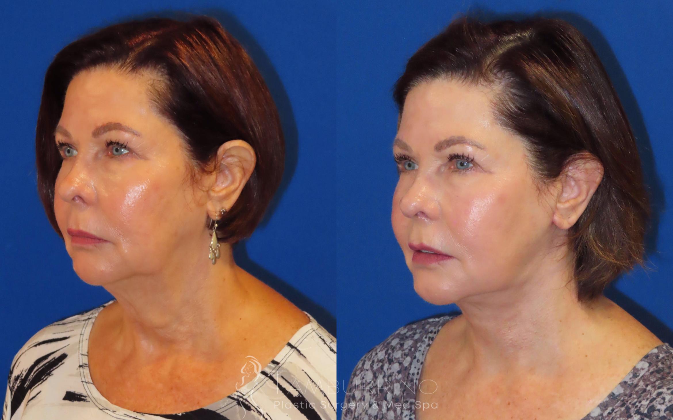Before & After Neck Lift Case 61 Left Oblique View in Doylestown, PA