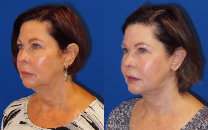 Before & After Neck Lift Case 61 Left Oblique View in Doylestown, PA