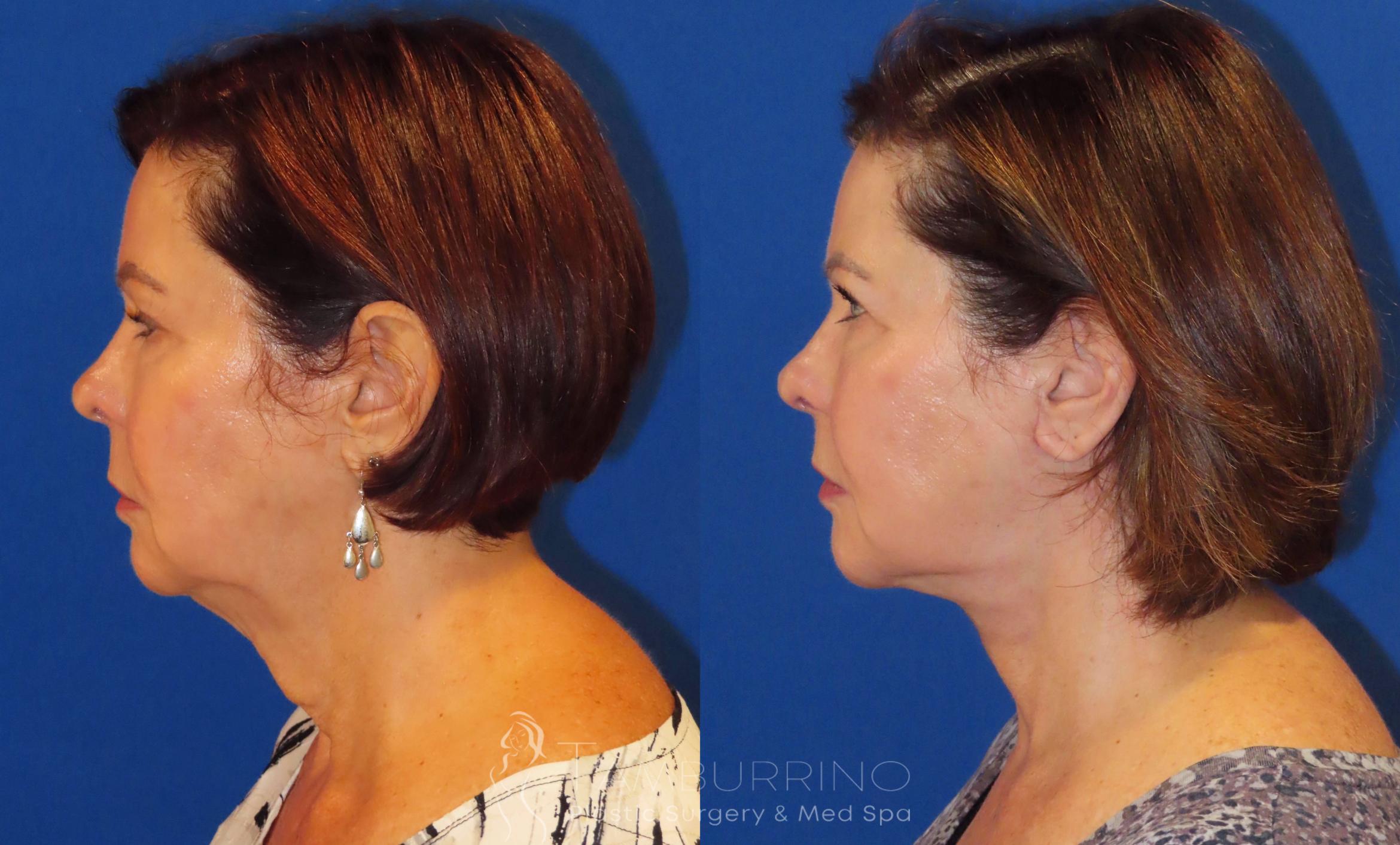Before & After Neck Lift Case 61 Left Side View in Doylestown, PA