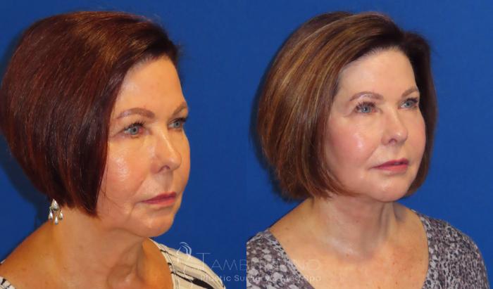 Before & After Neck Lift Case 61 Right Oblique View in Doylestown, PA