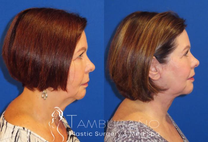 Before & After Neck Lift Case 61 Right Side View in Doylestown, PA