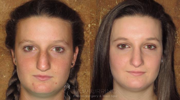 Before & After Rhinoplasty Case 1 Frontal View in Doylestown, PA