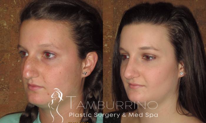 Before & After Rhinoplasty Case 1 Oblique #1 View in Doylestown, PA