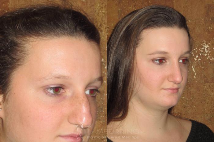 Before & After Rhinoplasty Case 1 Oblique #2 View in Doylestown, PA