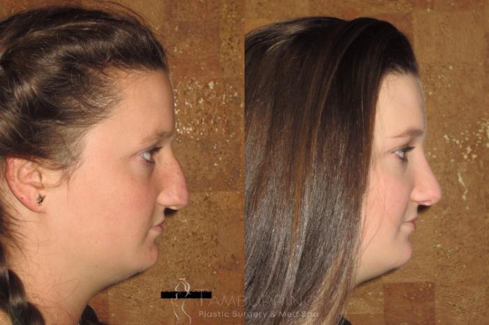 Before & After Rhinoplasty Case 1 Side View in Doylestown, PA