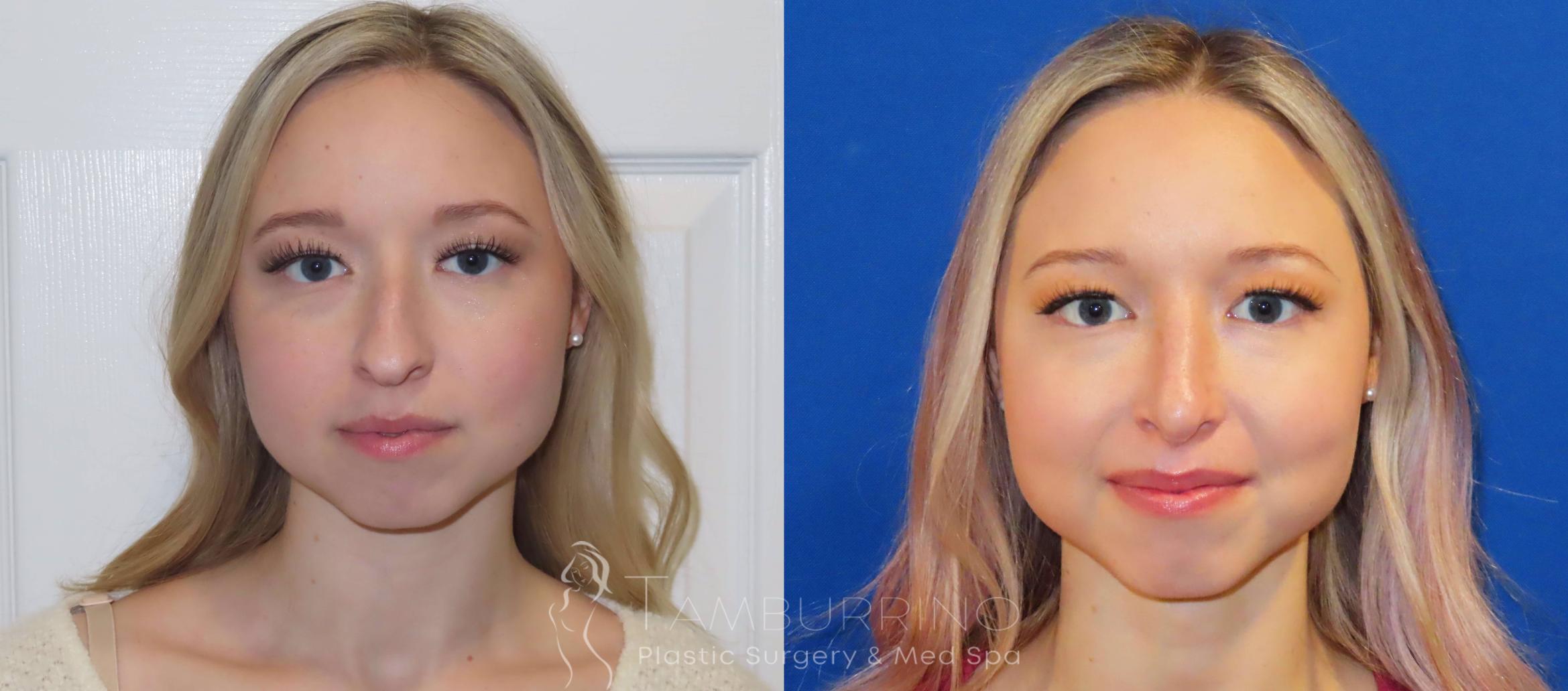 Before & After Rhinoplasty Case 12 Frontal Rhinoplasty View in Doylestown, PA